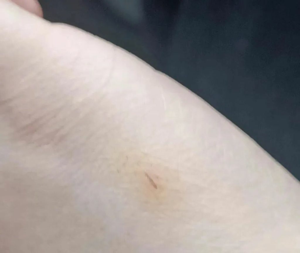 被宠物咬伤抓伤怎么办？狂犬疫苗接种全攻略 - 语梦星球